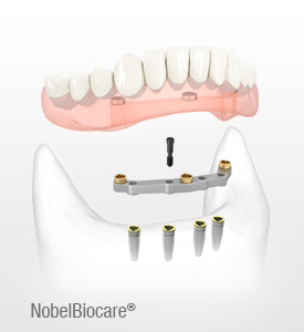 Implantes • Clínica Segarra Vidal - Implantes Implantes • Clínica Segarra Vidal - Implantes