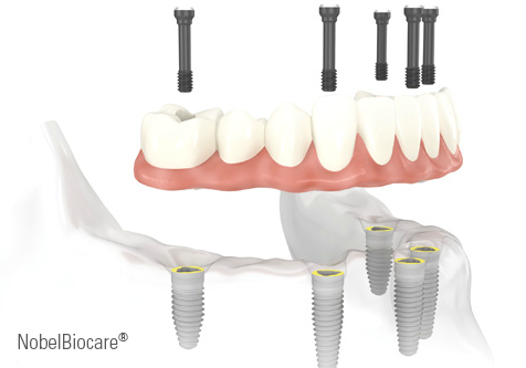 Implantes • Clínica Segarra Vidal - Implantes Implantes • Clínica Segarra Vidal - Implantes