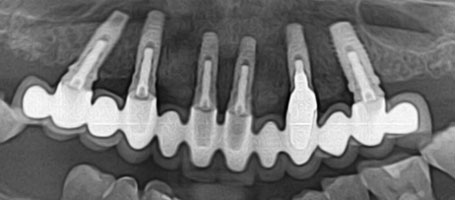 Implantes • Clínica Segarra Vidal - Implantes Implantes • Clínica Segarra Vidal - Implantes