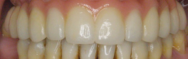 Implantes • Clínica Segarra Vidal - Implantes Implantes • Clínica Segarra Vidal - Implantes