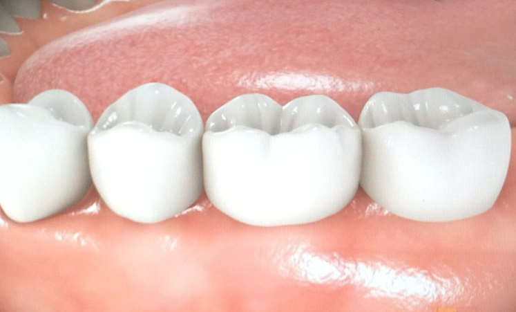 Implantes • Clínica Segarra Vidal - Implantes Implantes • Clínica Segarra Vidal - Implantes