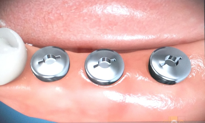 Implantes • Clínica Segarra Vidal - Implantes Implantes • Clínica Segarra Vidal - Implantes