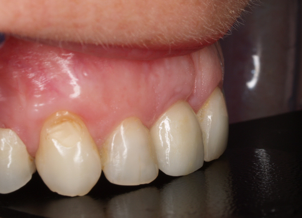 Implantes • Clínica Segarra Vidal - Implantes Implantes • Clínica Segarra Vidal - Implantes