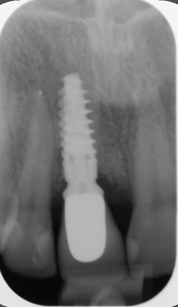 Implantes • Clínica Segarra Vidal - Implantes Implantes • Clínica Segarra Vidal - Implantes
