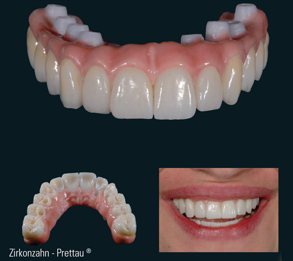 Implantes • Clínica Segarra Vidal - Implantes Implantes • Clínica Segarra Vidal - Implantes