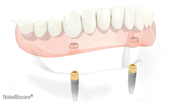 Implantes • Clínica Segarra Vidal - Implantes Implantes • Clínica Segarra Vidal - Implantes