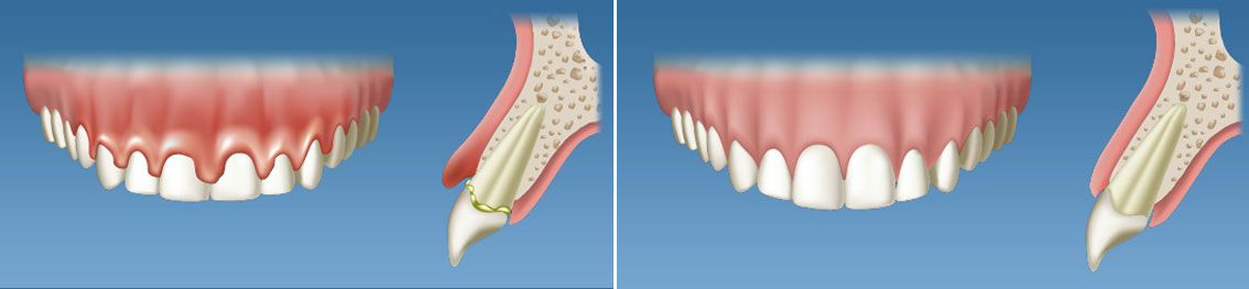 Periodoncia • Clínica Segarra Vidal - Periodoncia