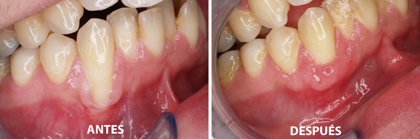 Periodoncia • Clínica Segarra Vidal - Periodoncia