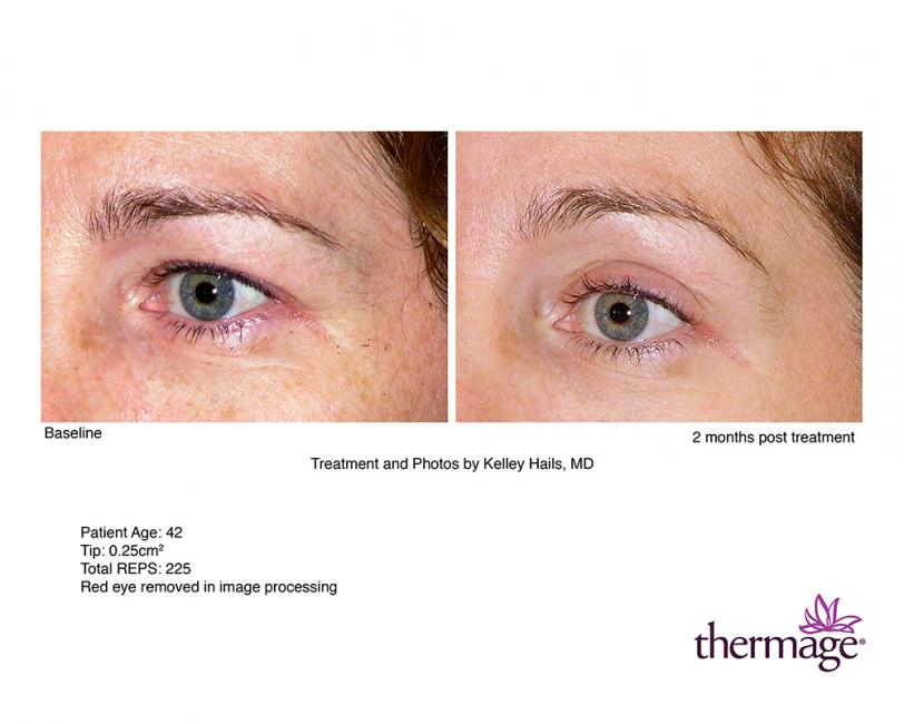Thermage • Clínica Segarra Vidal - Thermage Thermage • Clínica Segarra Vidal - Thermage