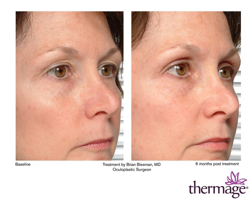 Thermage • Clínica Segarra Vidal - Thermage Thermage • Clínica Segarra Vidal - Thermage