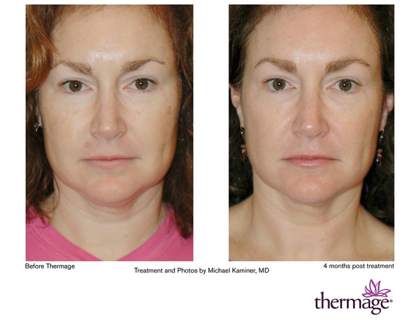 Thermage • Clínica Segarra Vidal - Thermage Thermage • Clínica Segarra Vidal - Thermage