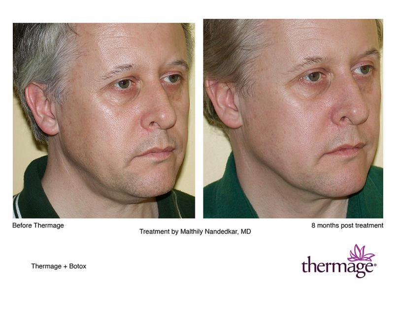 Thermage • Clínica Segarra Vidal - Thermage Thermage • Clínica Segarra Vidal - Thermage
