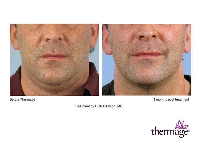 Thermage • Clínica Segarra Vidal - Thermage Thermage • Clínica Segarra Vidal - Thermage