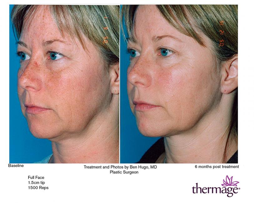 Thermage • Clínica Segarra Vidal - Thermage Thermage • Clínica Segarra Vidal - Thermage