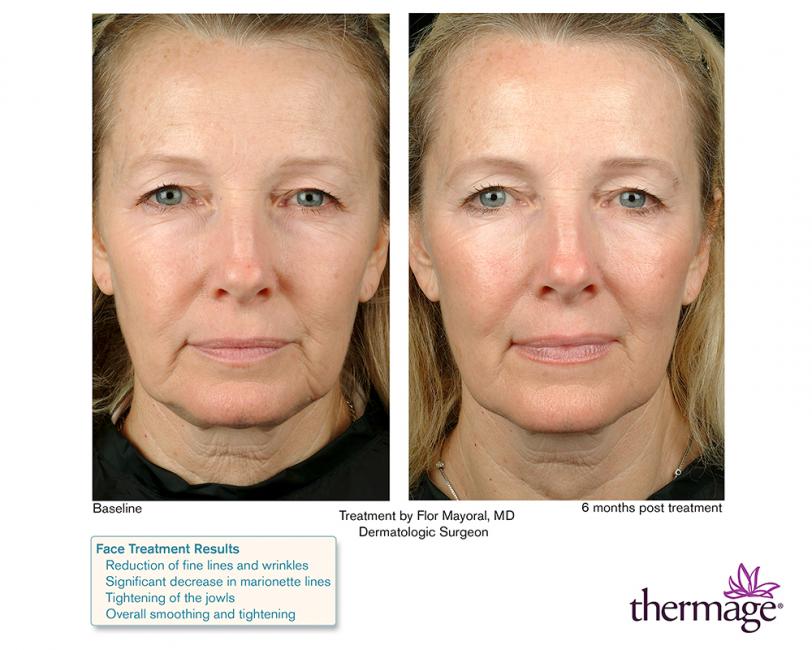Thermage • Clínica Segarra Vidal - Thermage Thermage • Clínica Segarra Vidal - Thermage
