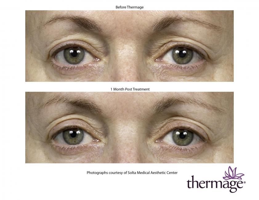 Thermage • Clínica Segarra Vidal - Thermage Thermage • Clínica Segarra Vidal - Thermage