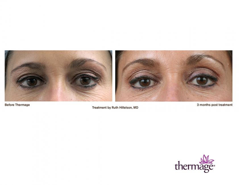 Thermage • Clínica Segarra Vidal - Thermage Thermage • Clínica Segarra Vidal - Thermage