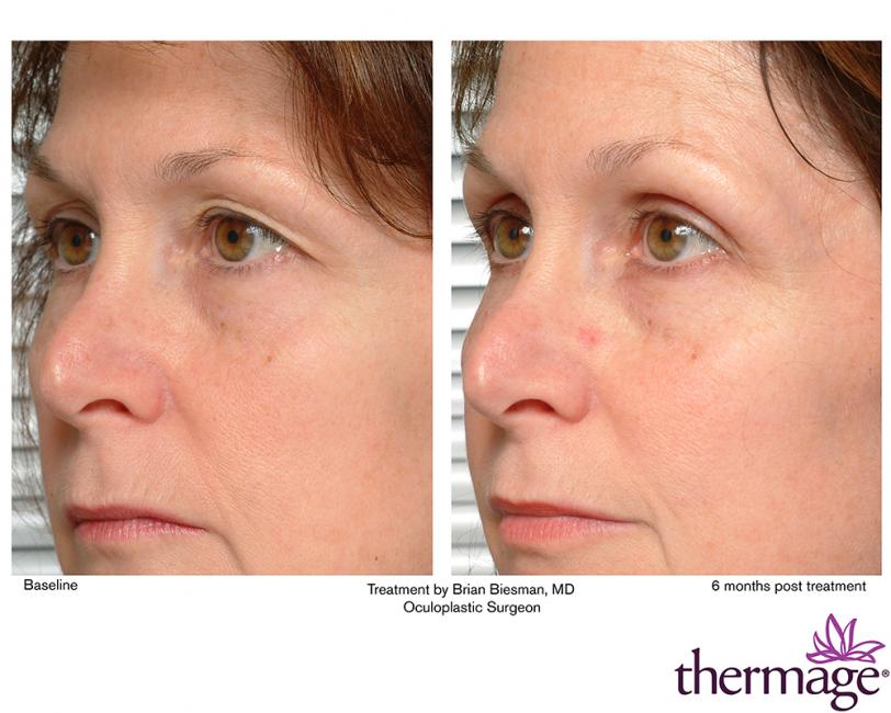 Thermage • Clínica Segarra Vidal - Thermage Thermage • Clínica Segarra Vidal - Thermage